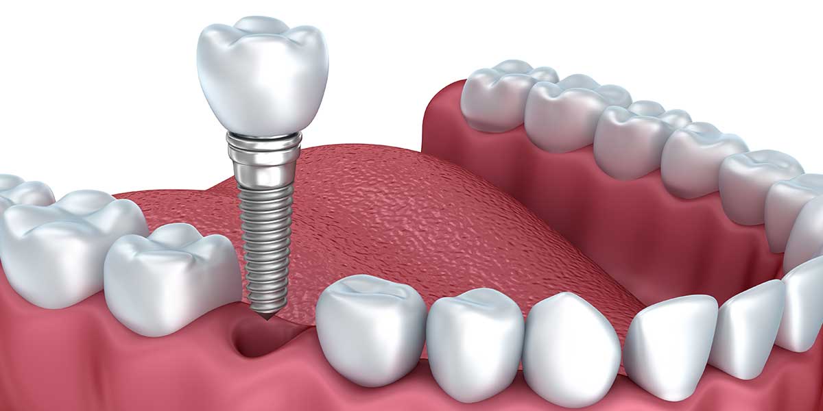 implants_megalo